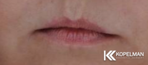 Lip Injections Before Photo